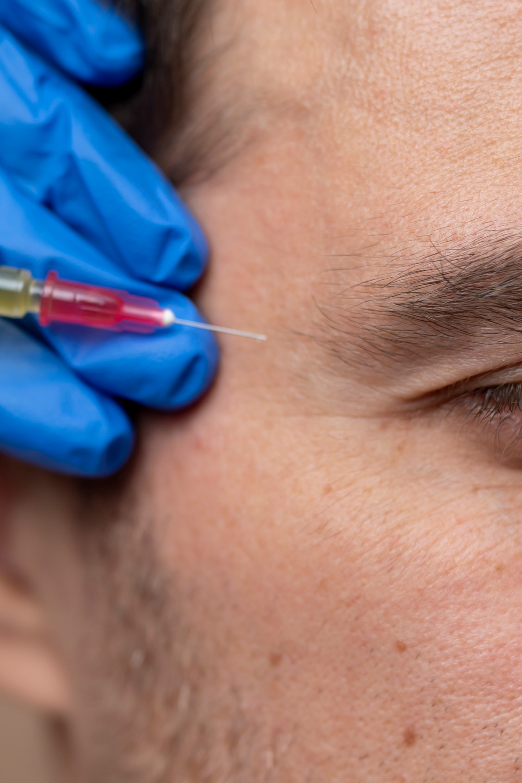 Resurfacing periocular CO2